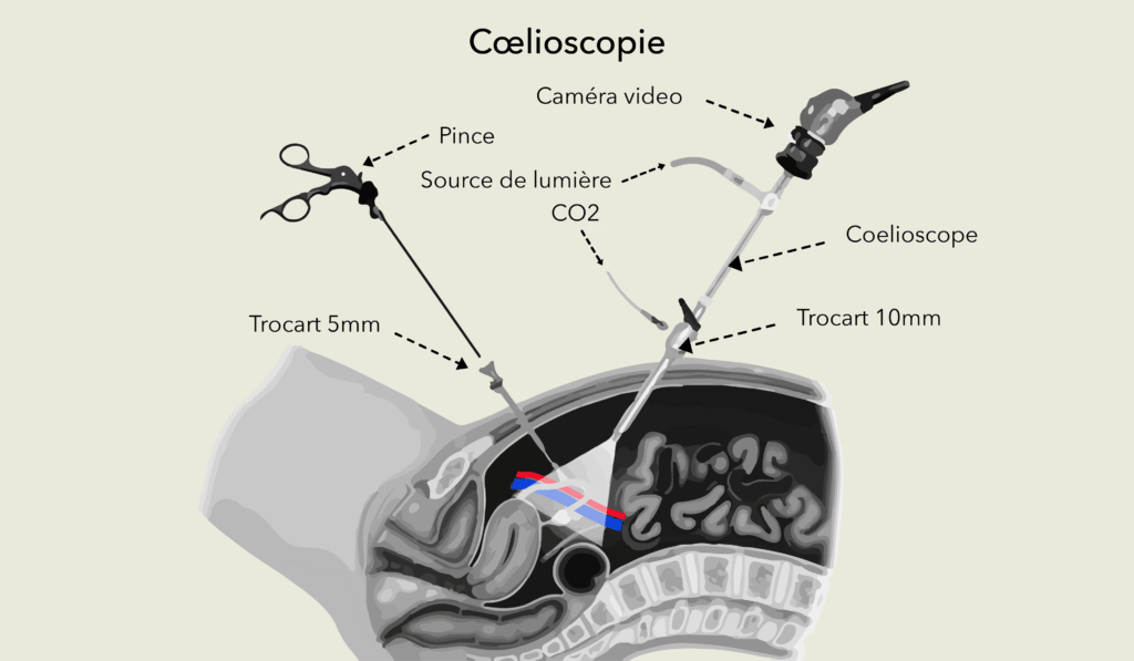 Coelioscopie Dr Olivier Marpeau Coelioscopie Dr Olivier Marpeau