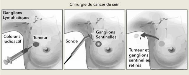 Cancers du sein Dr Olivier Marpeau