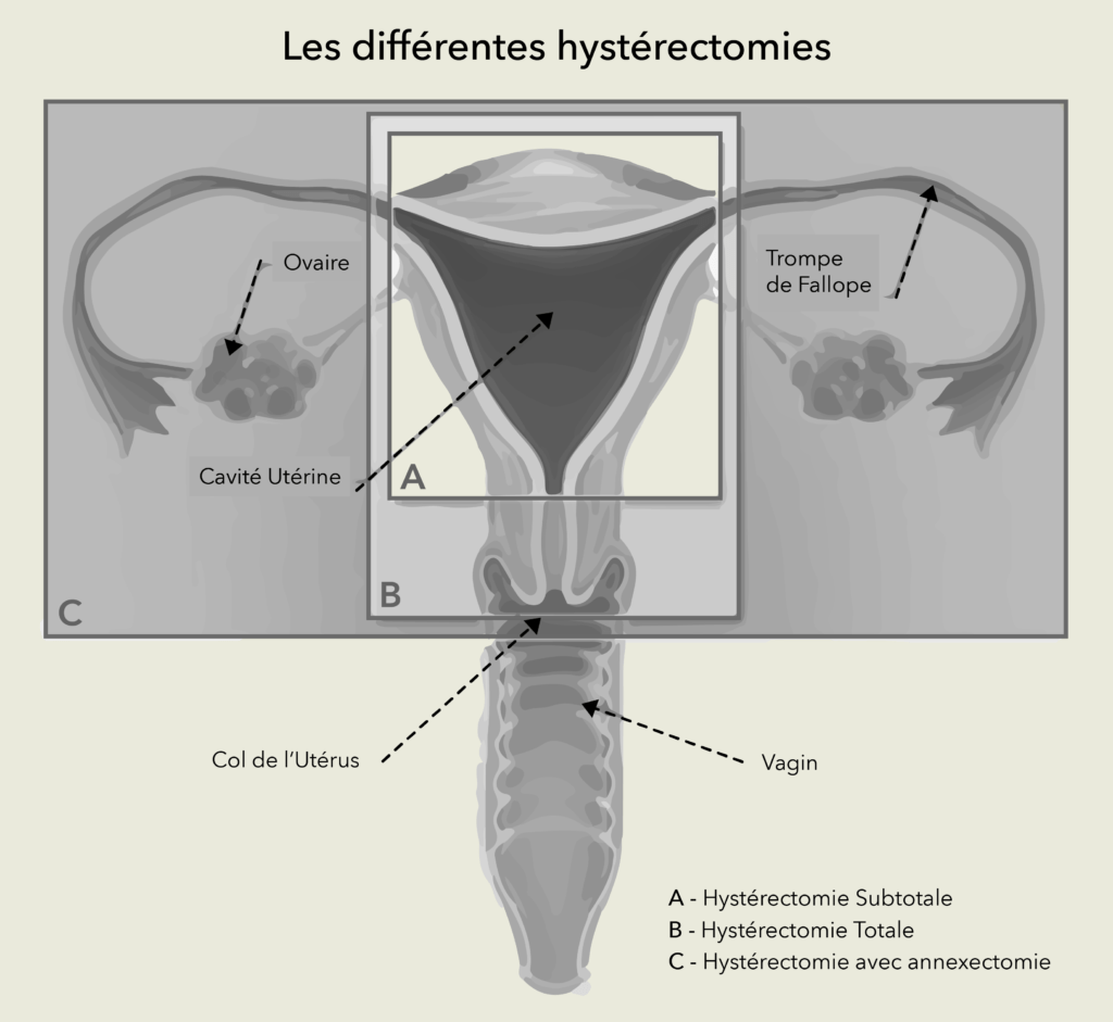 Hystérectomies Dr Olivier Marpeau Hystérectomies Dr Olivier Marpeau